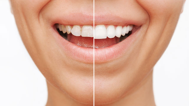 The image shows a close-up split comparison of a person's face with two contrasting expressions: on the left, a neutral expression, and on the right, an exaggerated smile revealing teeth.